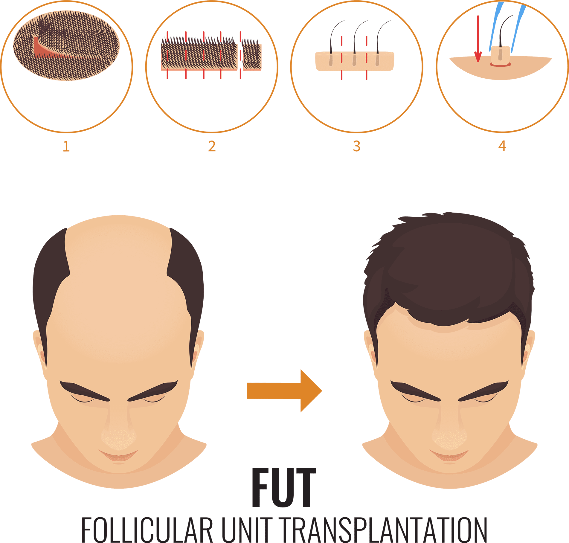 FUT hair transplant UK-diagram