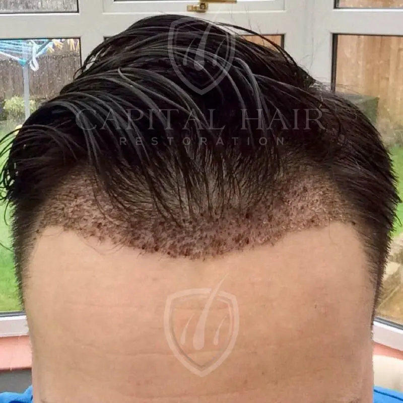 FUE hair transplant results day 9