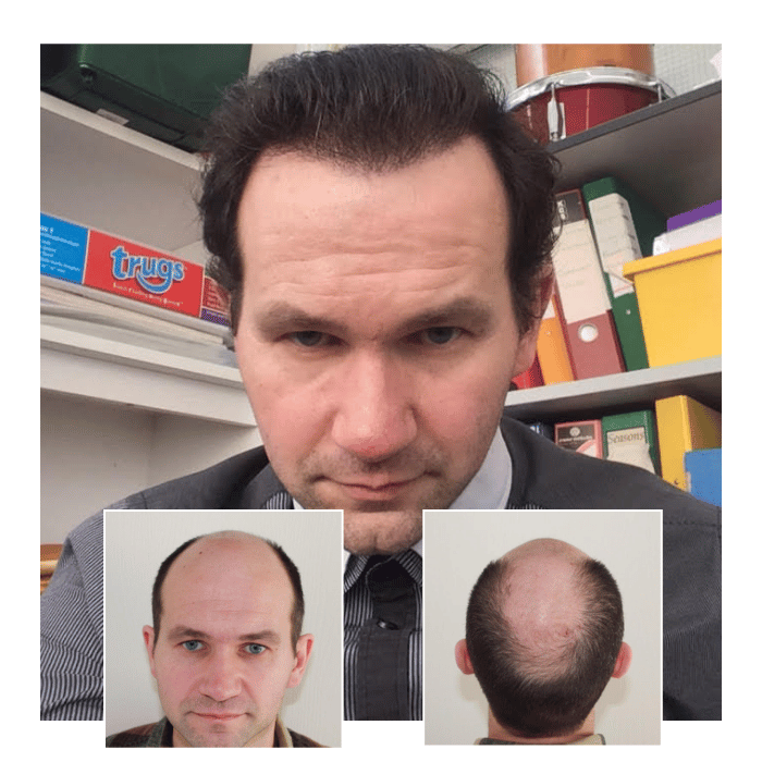 Before After Hair Transplant Manchester