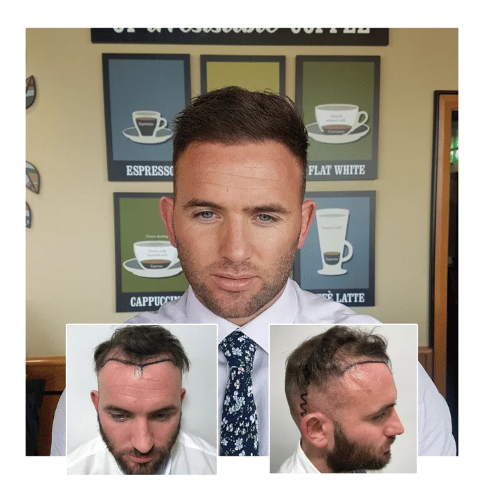 before after hair transplant birmingham 05