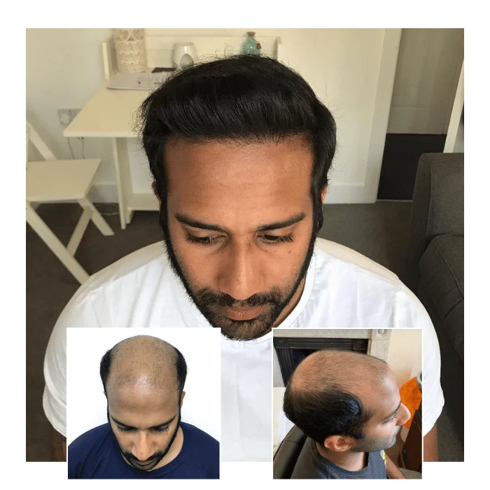 before after hair transplant oxford 02