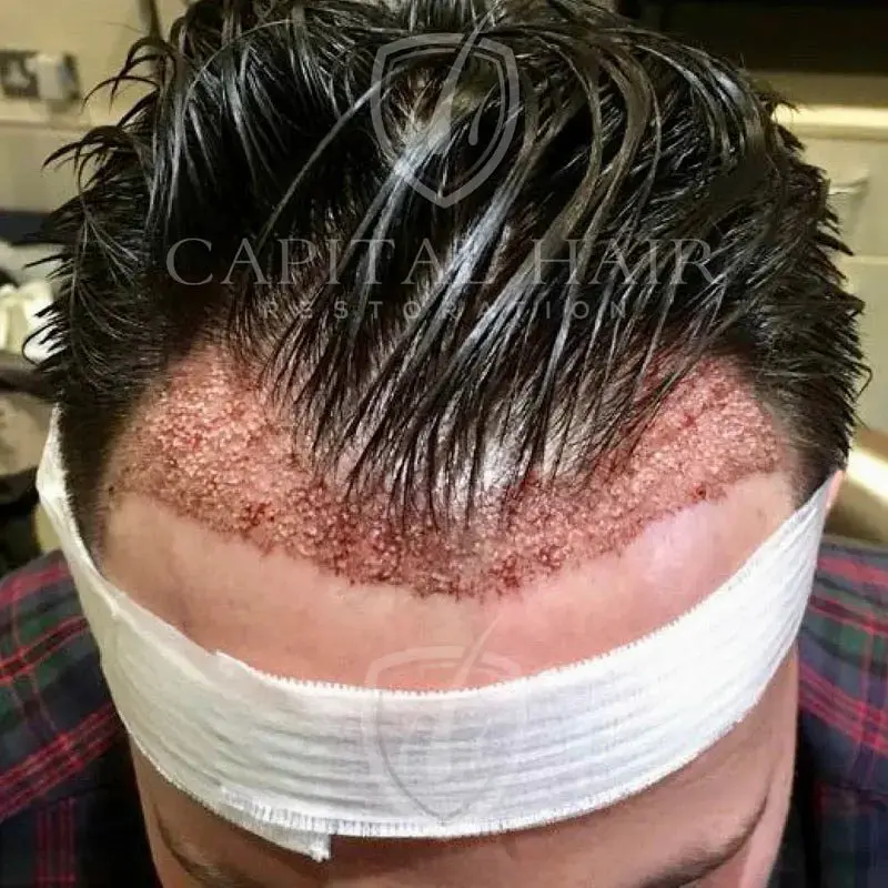 fut hair transplant results day 1