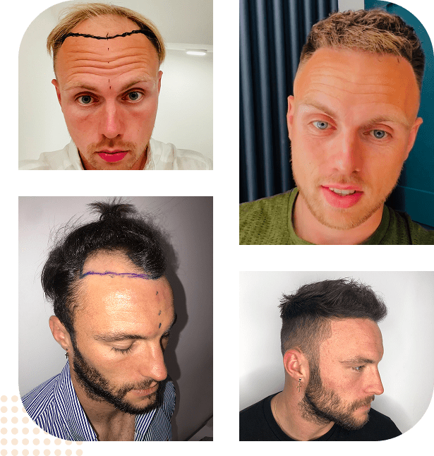 group before after hair transplant harley street london 01