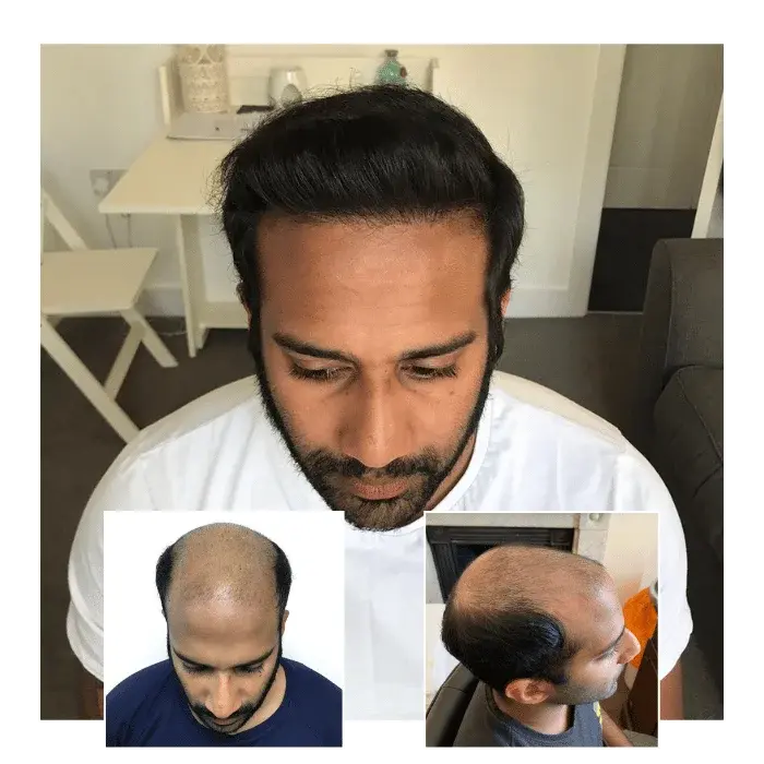 before after hair transplant guildford 02