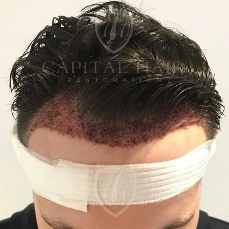 FUE hair transplant results day 2