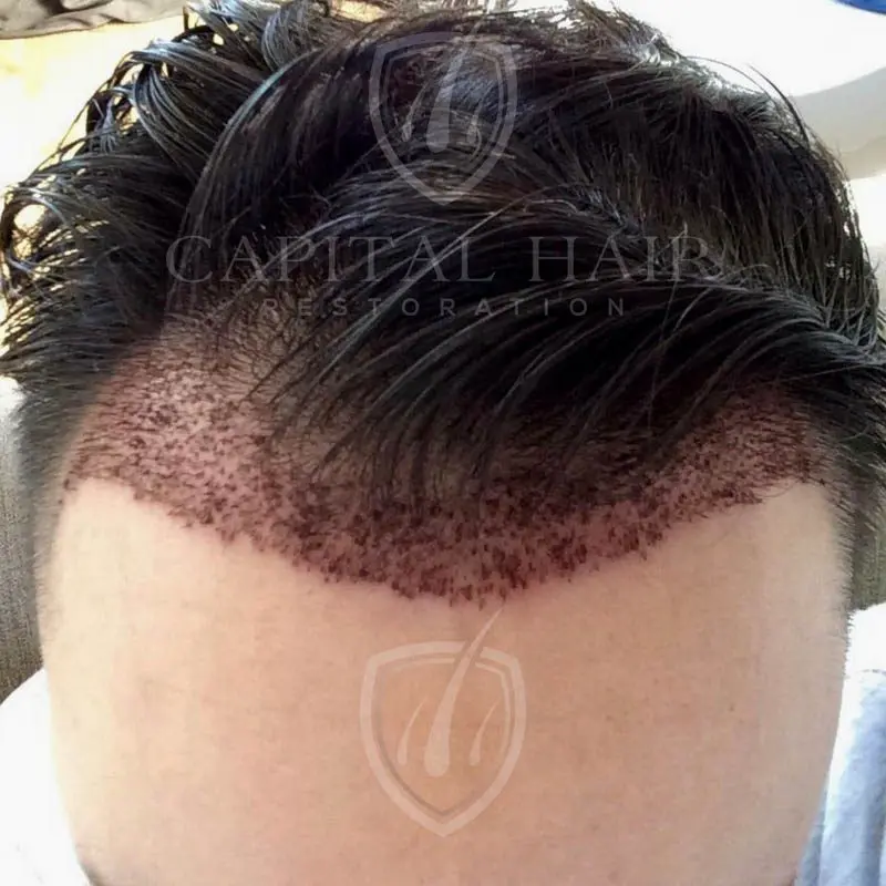 FUE hair transplant results day 3