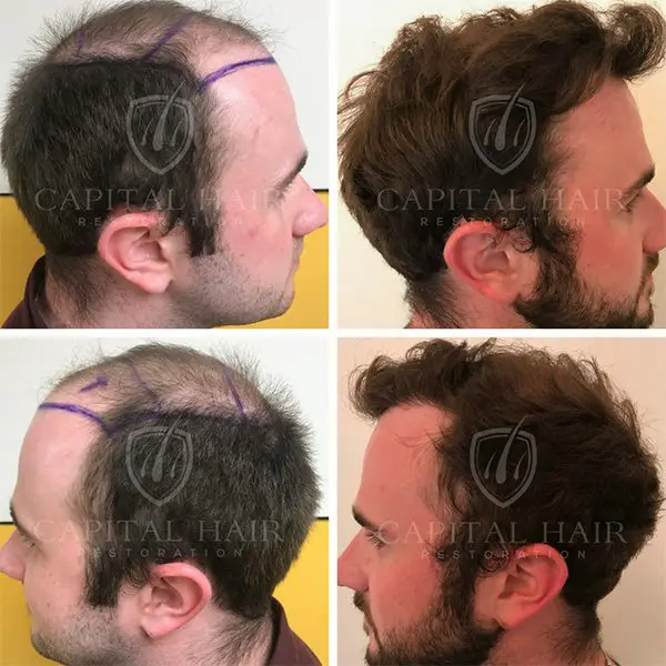 FUE Hair Transplant Before and After Conor Results UK