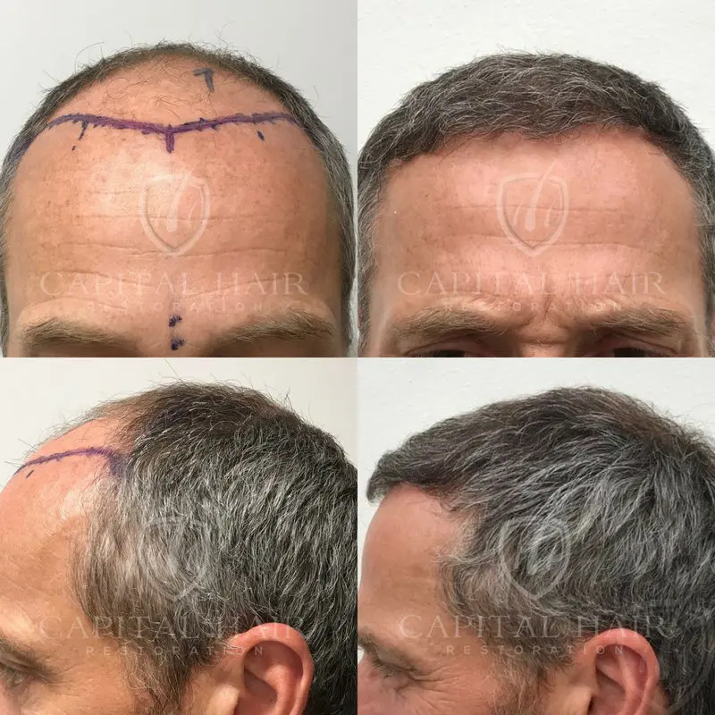 Before and After Graham Results