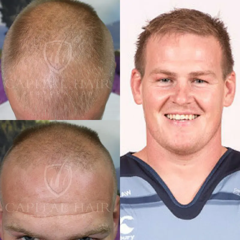 FUE Hair Transplant Before and After Rhys