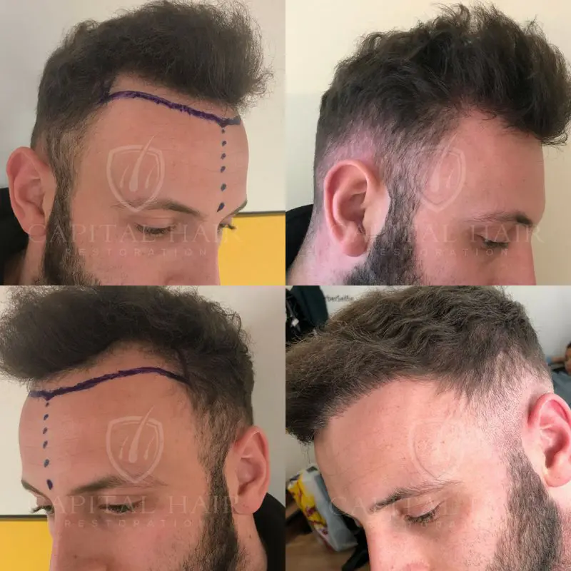 FUE Hair Transplant Before and After Ryan Results