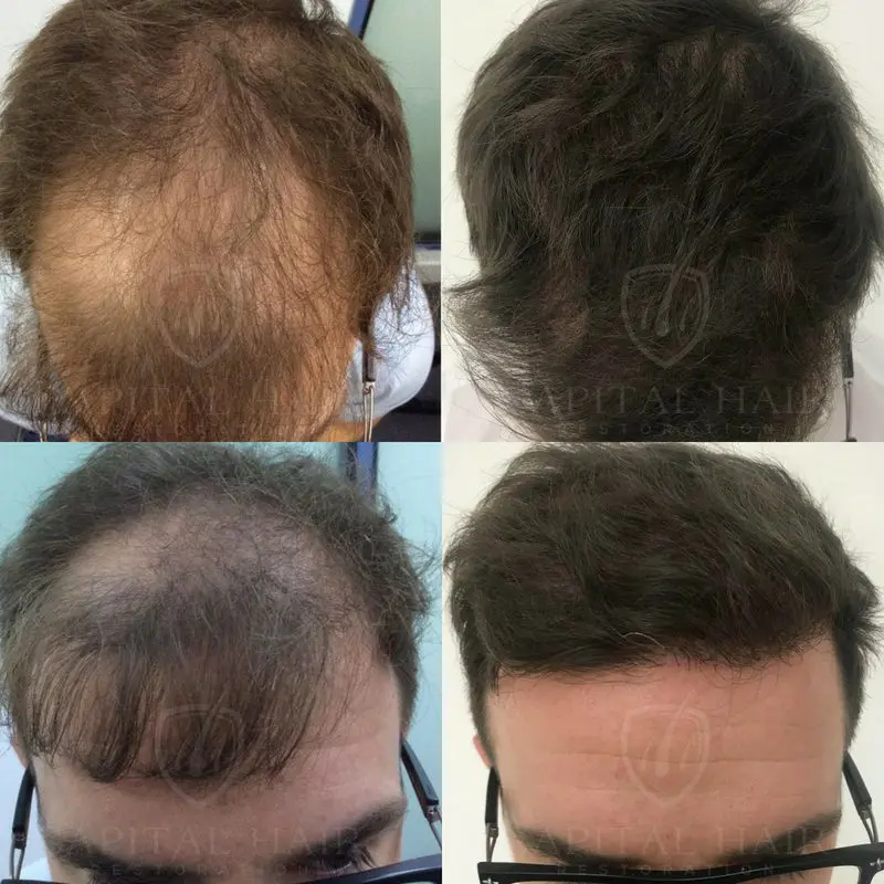 FUE Hair Transplant Before and After Results UK