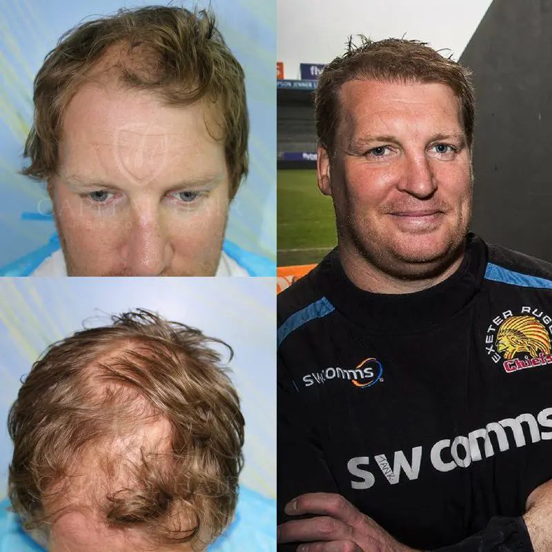 Hair Transplant Before and After