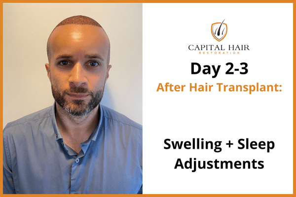 Man shown 2 to 3 days after hair transplant surgery with mild swelling, adjusting sleep position