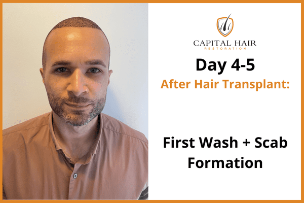 Man shown 4 to 5 days after hair transplant, marking the first wash and scab formation stage