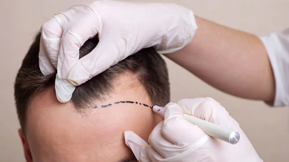 How Much Does a Transplant Cost in the UK ,head of a balding man