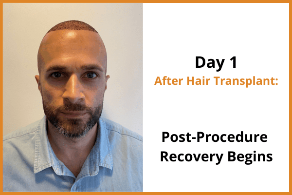 Man shown on day 1 after hair transplant surgery with closely shaved hair and beard, starting recovery