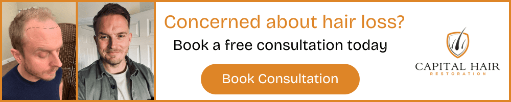 Before and after hair transplant photos with text "Concerned about hair loss? Book a free consultation today" and Capital Hair Restoration logo.