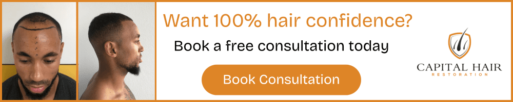 Before and after photos showing hair transplant results for a male patient with hairline restoration and side profile, promoting free consultation at Capital Hair Restoration.