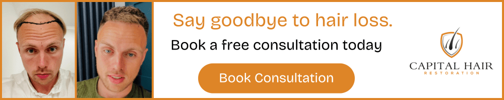Before and after photos of a man’s hair transplant results with text encouraging booking a free consultation