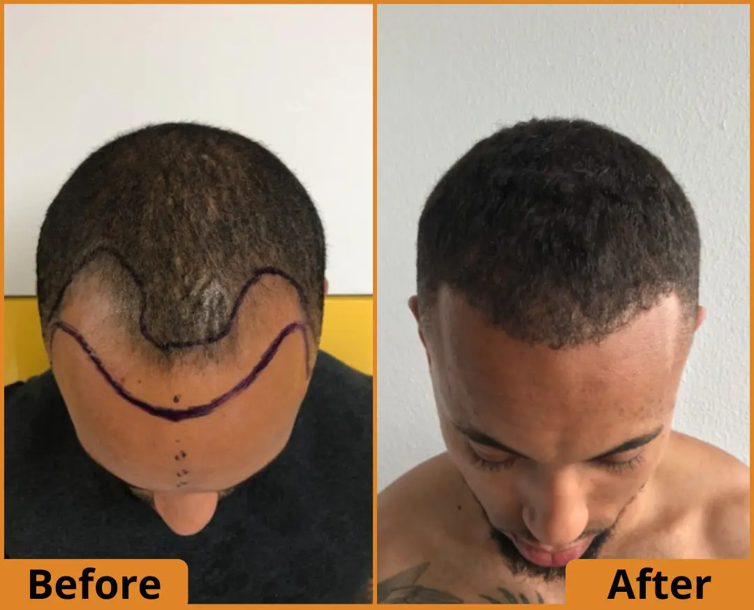 Afro Hair Transplant