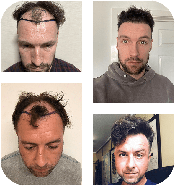 Before and after images of two male patients showing hairline restoration following FUE transplant