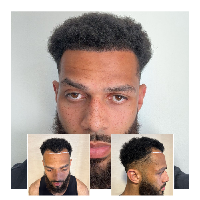 before after hair transplant cambridge 06