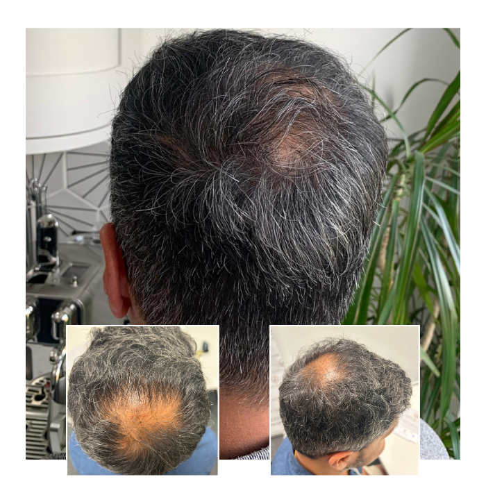 before after hair transplant oxford 01
