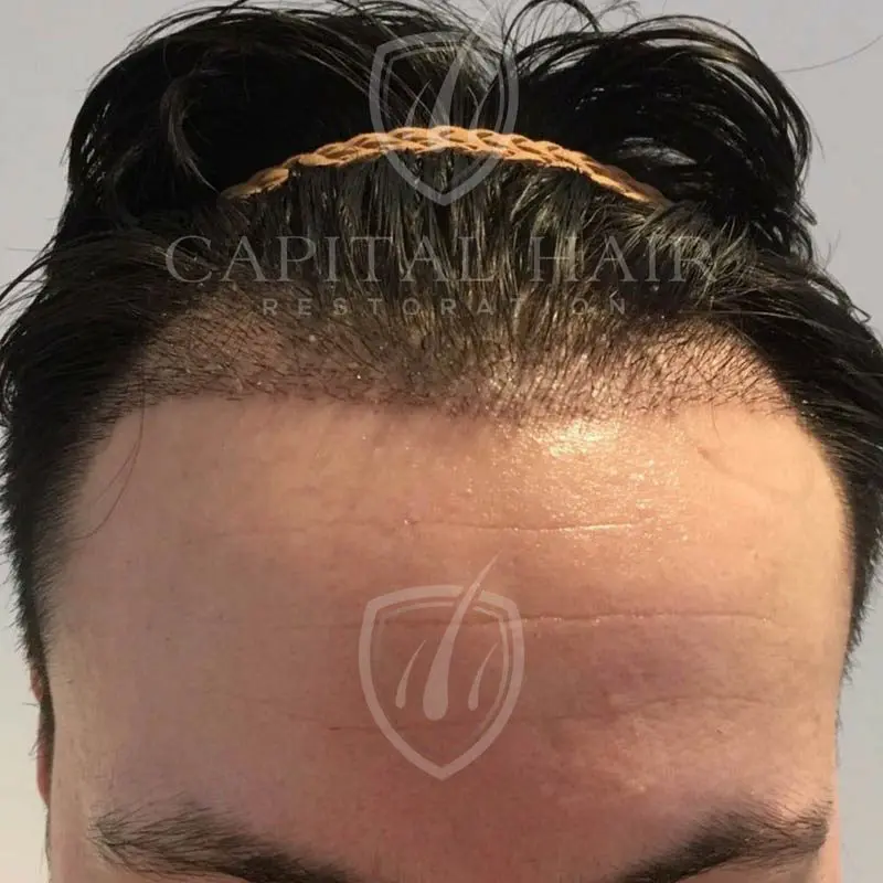 fut hair transplant results day 15
