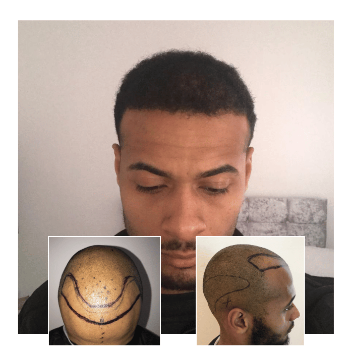 afro hair transplant clinic ipswich 02