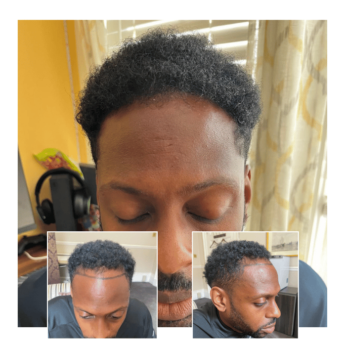 afro hair transplant clinic manchester 04