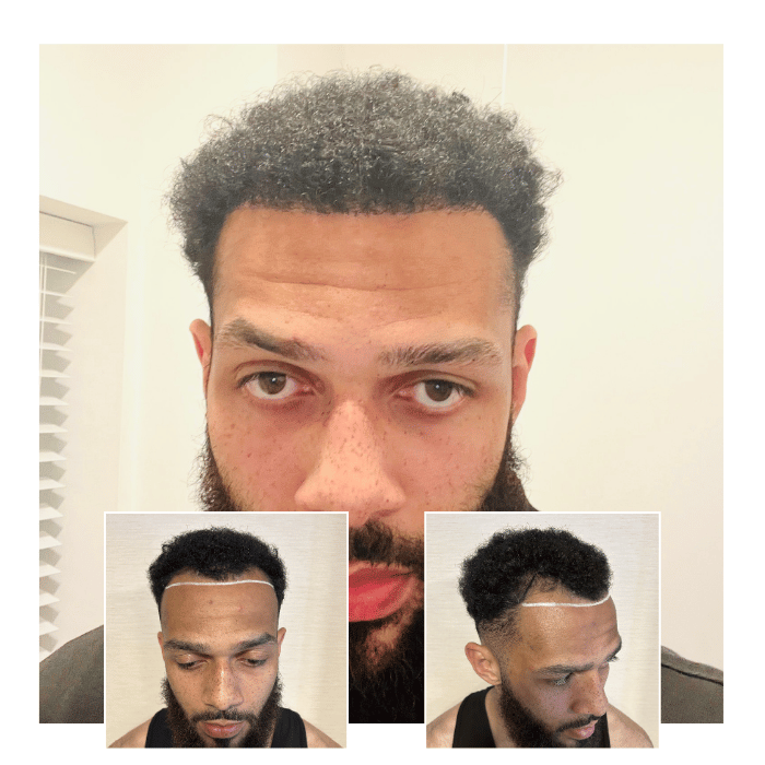 afro hair transplant clinic milton keynes 03
