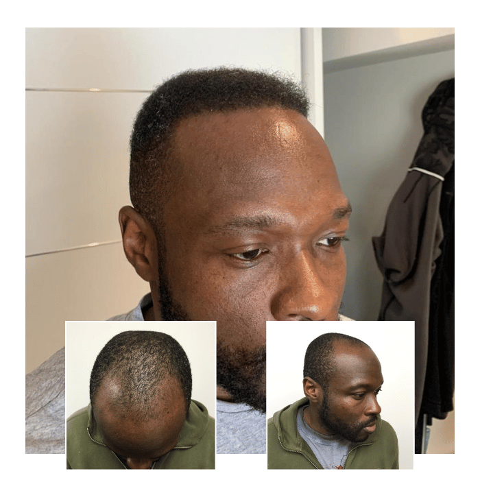 afro hair transplant clinic milton keynes 05