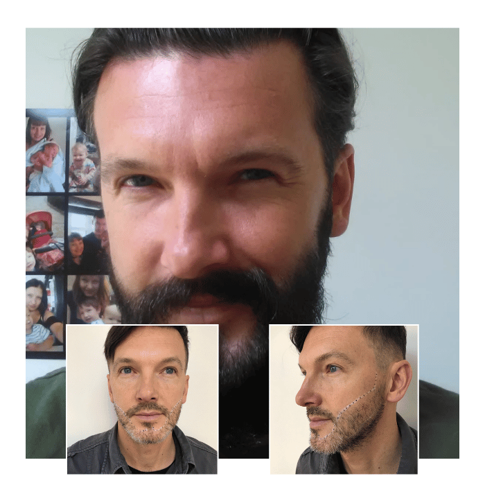 beard hair transplant brentwood 01
