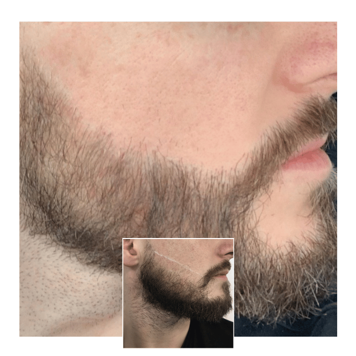 beard hair transplant london 02