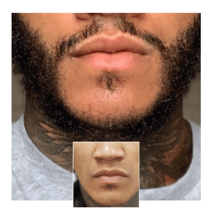 beard hair transplant london 03