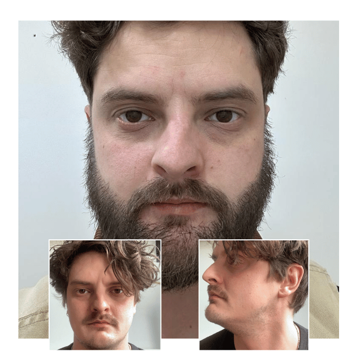 beard hair transplant luton 04