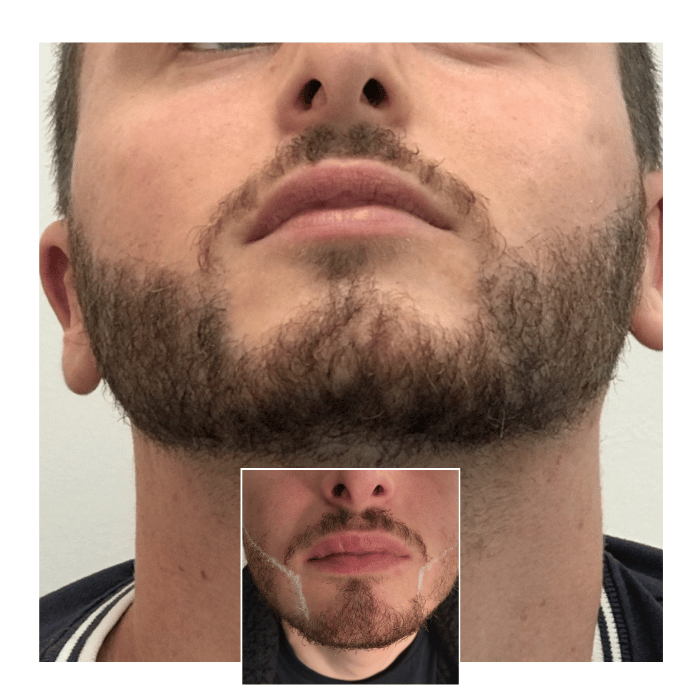 beard hair transplant manchester 05