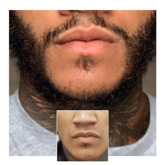 beard hair transplant canary wharf 02