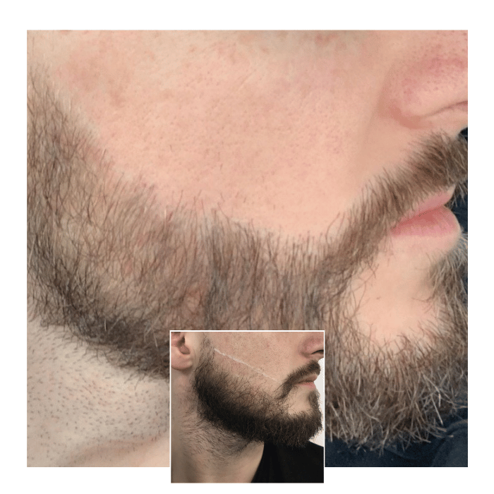beard hair transplant canary wharf 03