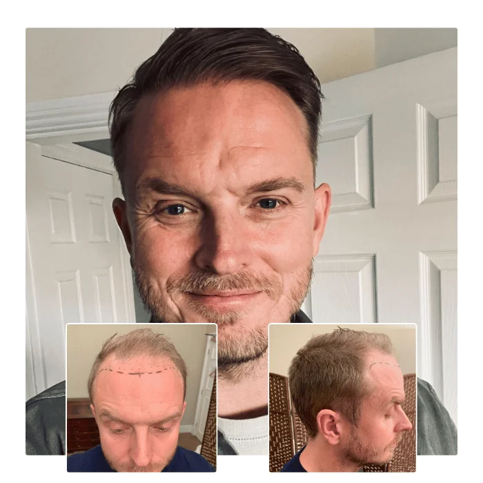before after hair transplant canary wharf london 03