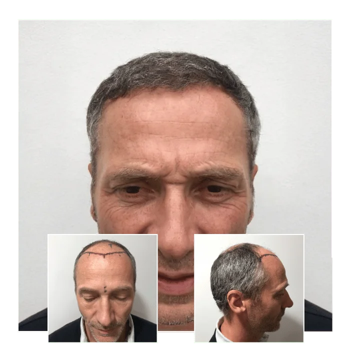 before after hair transplant canary wharf london 04
