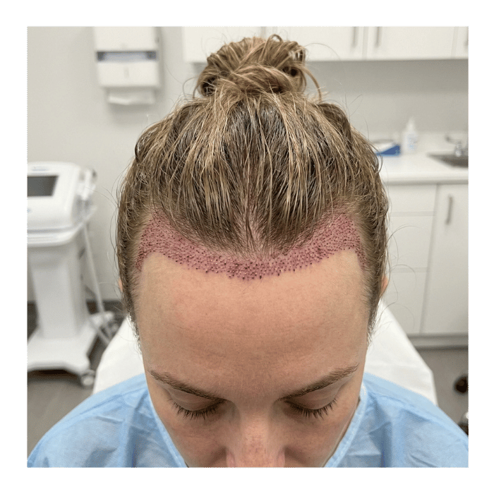 female hairline transplant topdown