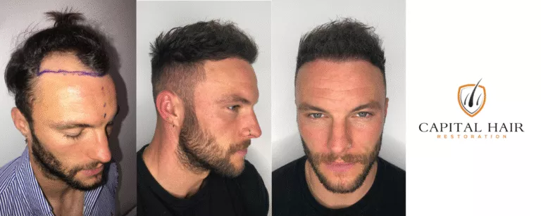 reduce pain after hair transplant,pain after hair transplant