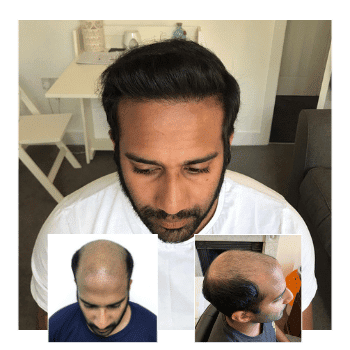 Hair Transplant Before & After Male