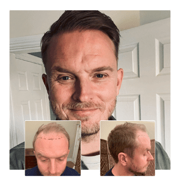 Hair Transplant Before & After Results