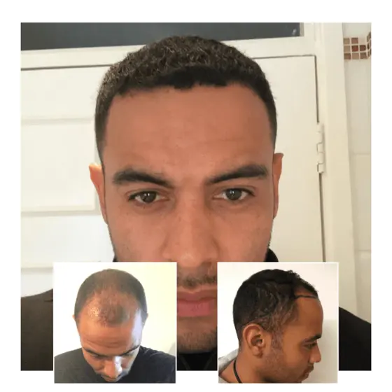 afro hair transplant male