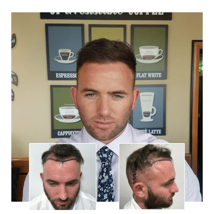 before after hair transplant brighton hove 06