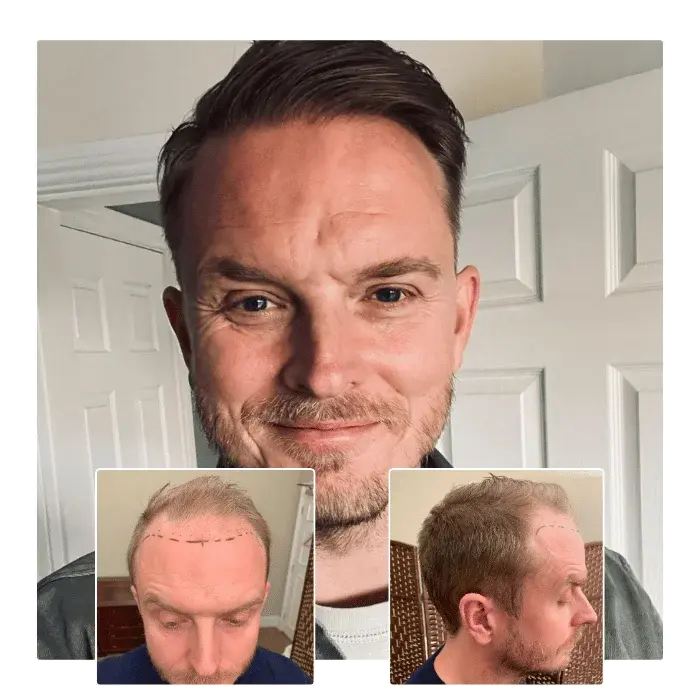 before after hair transplant chelmsford essex 03