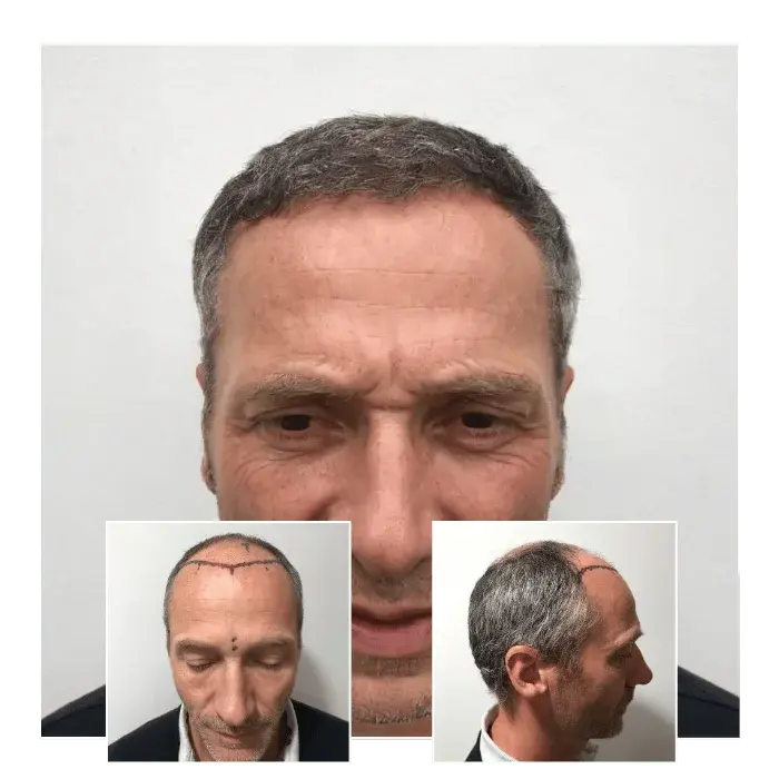 before after hair transplant chelmsford essex 04