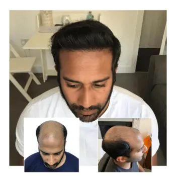 before after hair transplant guildford 02